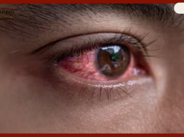 Eye flu Treatment : Eye flu is spreading fast, follow these 5 home remedies immediately to avoid this infection